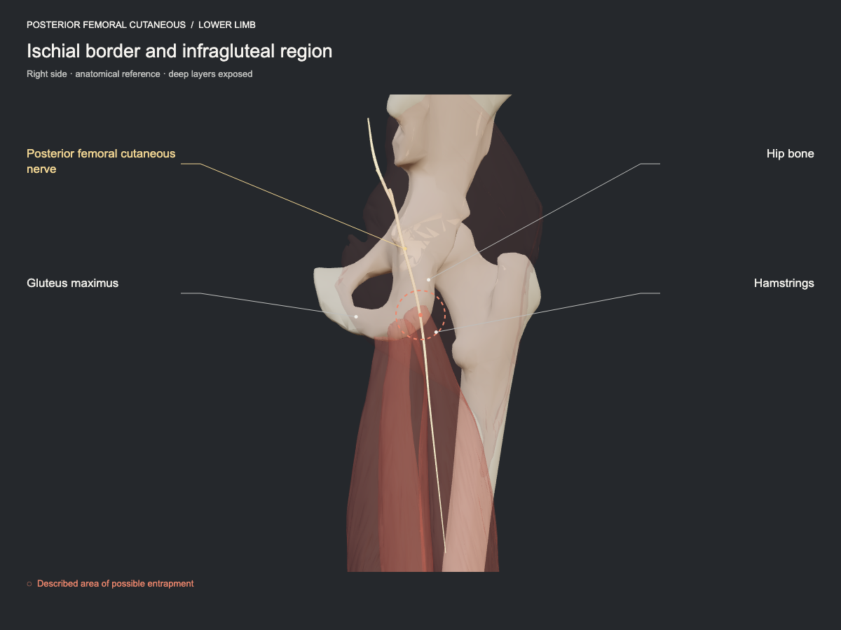 Ischial border and infragluteal region