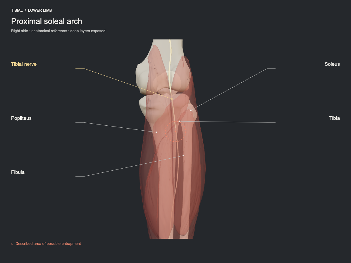 Proximal soleal arch
